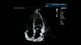 How to...Measure MR Vena Contracta