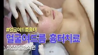 아침맑음한의원 얼굴여드름흉터 치료방법