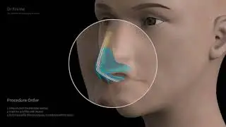 Solid Filler- Dr Frame PCL 3D Filler