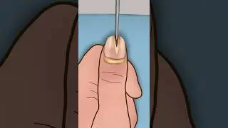 ASMR Satisfying splinter extraction #asmr #animation #trending #viral #shorts