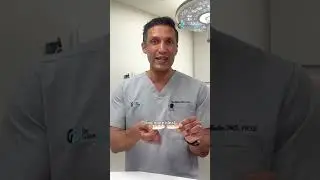 Acrylic or Zirconia for Full Arch Dental Implants?
