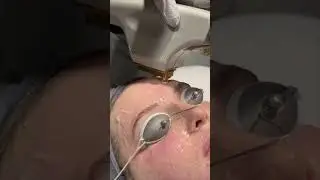 POV BBL Laser Treatment #bbl #lasertreatment