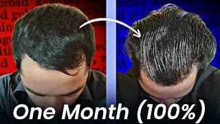 Grow Your Hairs Back (100% Guarented) | How To Grow Your Hairs | How To Receding Hair line ?