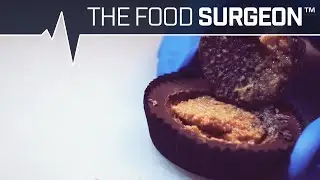 Reese's Peanut-Butter-Ectomy with Oreo Cream Transplant
