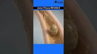 How does stone gets stuck into the ureter #rirs #urology