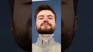 Снимаем гипс после рино 👃🏻 Этот день настал! @dr.semen.usov Результат ринопластики  #спб