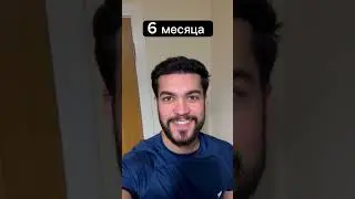 Результат пересадки волос с 1-го по 8-й месяц.Без боли, без следов, естественно. #пересадкаволос