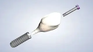 Implant Anatomy in Springfield IL | Oral & Facial Surgeons of Illinois