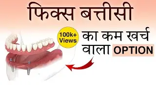 Overdenture for Fixed Teeth: My Full Experience, Procedure, Pain, Cost & Before-After Results