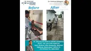 Successful recovery of leg weakness after spine surgery.