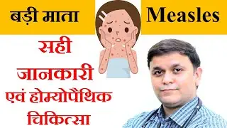 खसरा (Measles)- symptoms, diet, Homeopathic treatment & घरेलू उपचार #PatientEducation