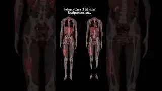 ewing sarcoma of femur #shorts