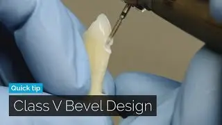 Class V Composite Bevel Design | DOTHANDSON