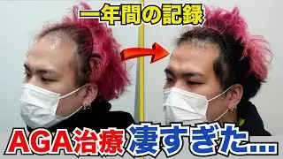 【忖度なし】薄毛治療から1年経過　生えた？金額は？クリニックは？すべてお答えします！