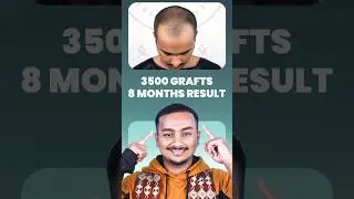 Hair Restoration at Its Best | Bangladesh #hairrestoration #bangladesh #shorts #ytshorts