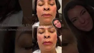 Natural looking #lipfiller for balance and #antiaging &hellip;. #austin #austintx #lips #lipinjections