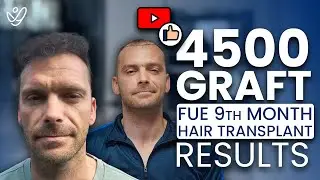 4500 Graft FUE Hair Transplant The Unexpected 9 Month Result!