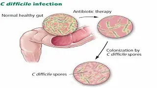 Clostridioides difficile Infection, including Recurrent and Refractory Diseases