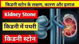 किडनी स्टोन का इलाज | पथरी का इलाज | Kidney Stone Treatment in Hindi