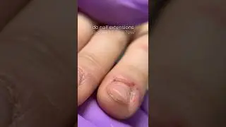 Extremely bitten nails transformation #nails #nailtransformation