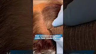 Last van dun haar? Kies voor micro haar pigmentatie! #kaalheid #microhaarpigmentatie #stoppeltattoo