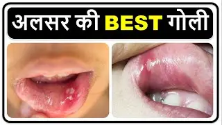 अलसर की BEST गोली, BEST tablet Mouth Ulcer,
