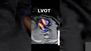 FETAL ECHO WITH COLOR DOPPLER