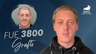12 Months Later: 3800 Grafts Hair Transplant | Smile Clinic