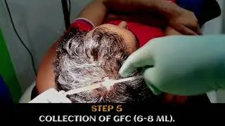 Advanced GFC PRP treatment in Bangalore