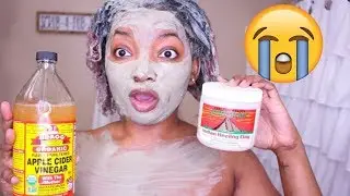 1 Year later! Aztec Clay Mask on Hormonal Acne + Colored Treated Natural Hair!