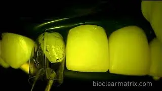 Bioclear Composite Veneers for Undersized Teeth  Part 2