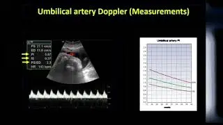 Obstetrics Doppler made easy/ summary of obstetric doppler/ Easiest way to understand doppler