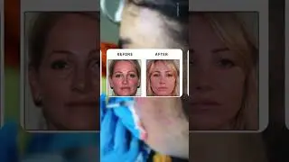 PRF Platelet Rich Fibrin helps treat acne scars