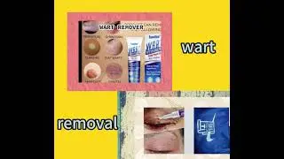 liquid wart removal pen descaling  Wart Remover & Wart Cream