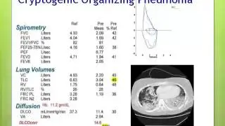 Late Complications After Allogeneic Transplant: Diagnosis & Treatment