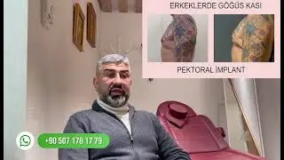Male Pectoral Implant  II Result - Before - After