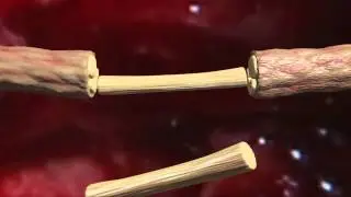 Sural nerve graft animation
