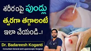 దెబ్బలు, పుండ్లు, గాయాలు త్వరగా తగ్గాలంటే ఇలా చేయండి ..! | wound healing | Dr.Badareesh | Unihealth