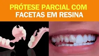 Prótese flexível (antes e depois) e facetas de resina.