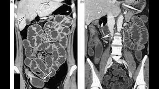 CT Enteroclysis Procedure