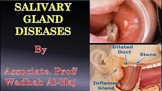 15- Salivary gland diseases. Dr Wadhah Oral medicine lectures.  د/ وضاح الحاج
