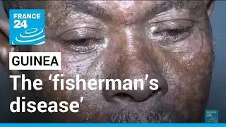 Official investigation launched on the &lsquo;fisherman&rsquo;s disease&rsquo; in Guinea &bull; FRANCE 24 English