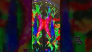 How Much Radiation Does MRI Use? 
