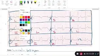 12 Lead Identification