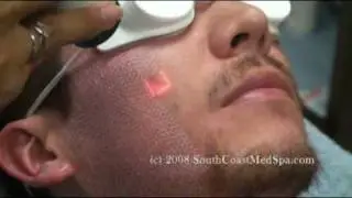 Active FX Laser Acne Scars Removal