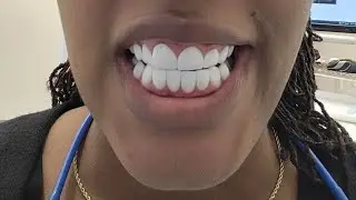 Dr. Gonzaga Tabares veneers 3 month update REGRETS