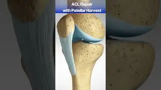 Что происходит, когда вы разрываете свой ACL