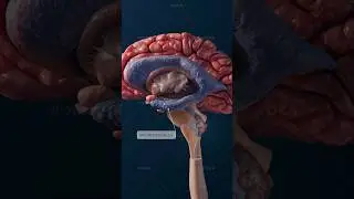 Ependymoma: a rare central nervous system tumor explained in 3D