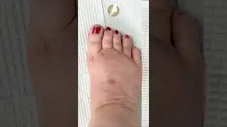 MIS Toe Deformity Correction
