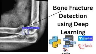 Bone Fracture Detection using Deep Learning | Python Final Year Project IEEE 2025